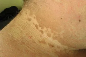 Tinea versicolor tabletták férfi