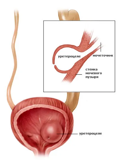 Ureterocele nőknél okoz, tünetek és a kezelés a betegség (tünetek) Ureterocele nőknél okoz, tünetek és a kezelés a betegség