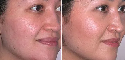 Ultrahangos tisztító személy nem, hogy mit lehet várni, fényképek és ár (fotó) Ultrahangos tisztító személy nem, hogy mit lehet várni, fényképek és ár