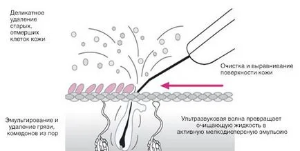 Ultrahangos tisztító személy nem, hogy mit lehet várni, fényképek és ár (vélemény) Ultrahangos tisztító személy nem, hogy mit lehet várni, fényképek és ár