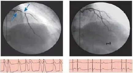 vasospasticus angina