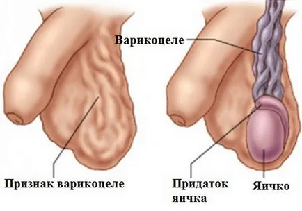 Varicocele férfiaknál, azaz a tünetek és a kezelés