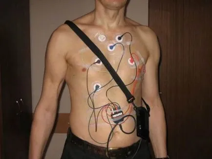 Érgörcsös angina okai, tünetei és kezelése (ok) Vasospasticus angina okai, tünetei és kezelése