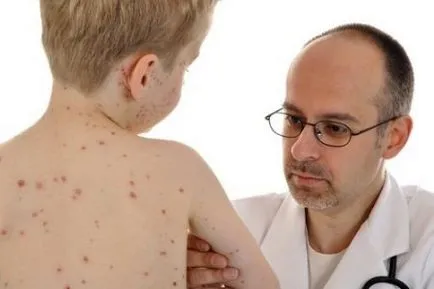 Vírusos bőrhólyagosodás gyermekeknél, ami (bladderwort) Vírusos bőrhólyagosodás gyermekek, mi ez