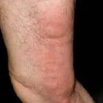 Mindent a vénás trombózis, thrombophlebitis és kezelésük