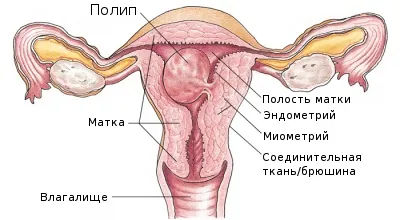 Rostos mirigyes méhnyálkahártya polip diagnózis és a kezelés