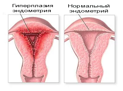 Mirigyes endometrium hiperplázia, mi ez