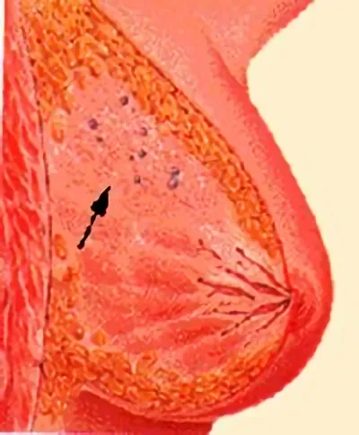 Glandular breast kezelésére és megelőzésére (kezelés) Glandular breast kezelése és megelőzése
