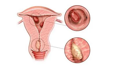 Mirigyes szálas polip endometriya- annyit kell tudni róla