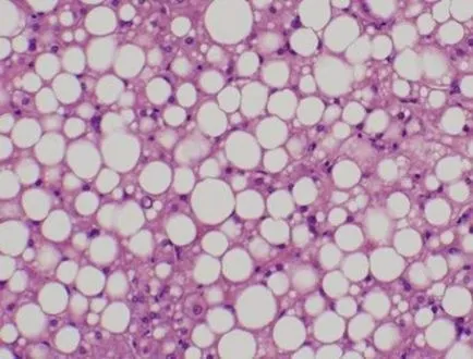 Adipose máj-degeneráció tünetei, gyógyszeres kezelés, étrend (zsír) Zsíros degeneráció a máj tünetek, kezelés, étrend