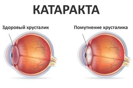 Milyen betegség szürkehályog