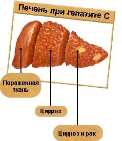 HCV vérvizsgálat, mi ez HCV vérvizsgálat, mi ez