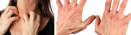 Dermatitis, mit kell tenni