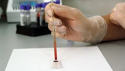 HCV vérvizsgálat, mi ez