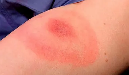 Allergiás a harapás szúnyogok