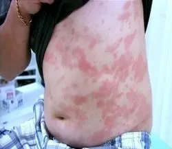 Ne vegye allergiásak a hadsereg Ne vegye allergiásak a hadsereg