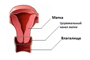 Vetése a méhnyakon, hogy