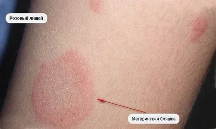 Hogyan gyógyítja ótvar gyermekeknél