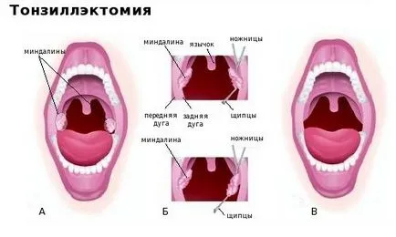 A horkolás, mit kell tenni A horkolás, mit kell tenni