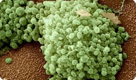 Mi a gonorrhea betegség Mi a gonorrhea betegség