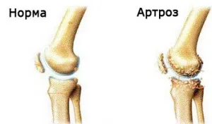 Kezelése arthrosis deformans népi jogorvoslat