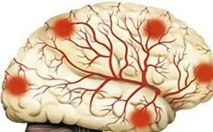 agy encephalopathia kezelésére