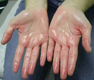 Hyperhydrosis megállítani