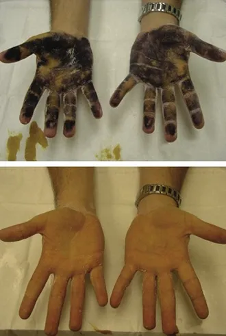Hyperhydrosis megállítani