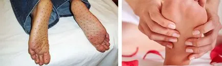 Hyperhydrosis megállítani