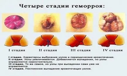 Aranyér kezelése a terhesség alatt Aranyér kezelése a terhesség alatt