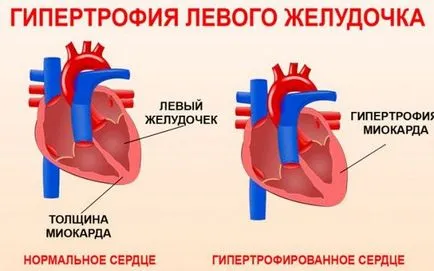 Kezelése hipertrófia a balkamra a szív