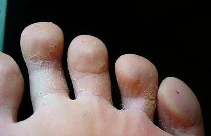 Hyperhydrosis megállítani