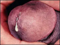 Mi a gonorrhea betegség