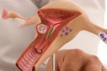 Méhen belüli hormonális spirál