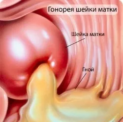 Mi a gonorrhea betegség Mi a gonorrhea betegség