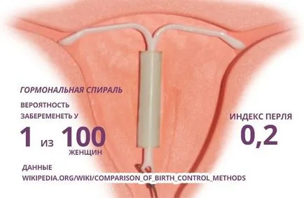 Méhen belüli hormonális spirál Méhen belüli hormonális spirál