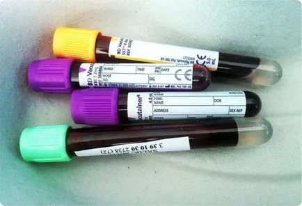 HCV vérvizsgálat, mi ez HCV vérvizsgálat, mi ez