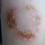 Az impetigo mi ez