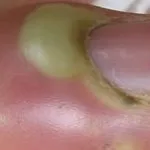 Az impetigo mi ez