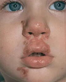 Az impetigo mi ez