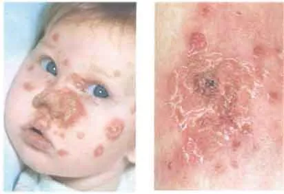 Az impetigo mi ez Az impetigo mi ez