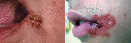 Az impetigo mi ez Az impetigo mi ez