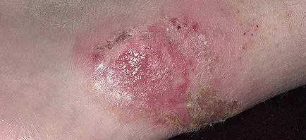Az impetigo mi ez Az impetigo mi ez