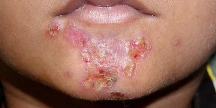 Az impetigo mi ez Az impetigo mi ez