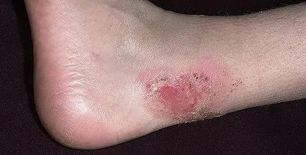 Az impetigo mi ez Az impetigo mi ez