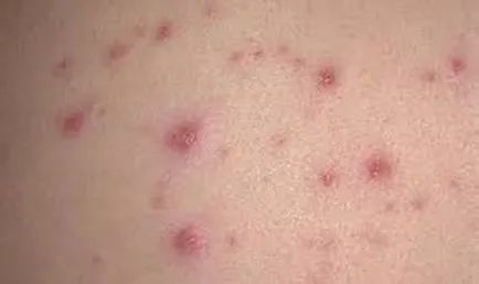 Az impetigo mi ez Az impetigo mi ez