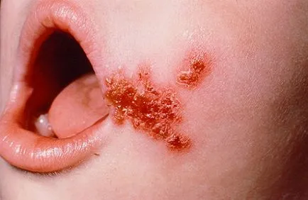Az impetigo mi ez