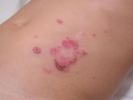 Az impetigo mi ez