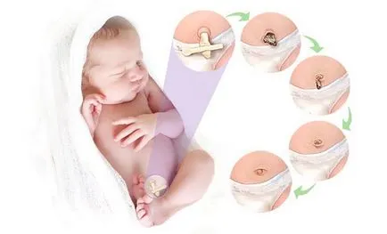Hogyan kezeljük a köldök újszülött