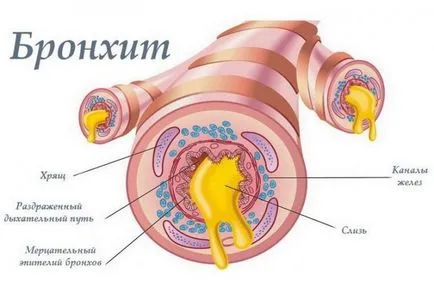 Hogyan működik bronchitis